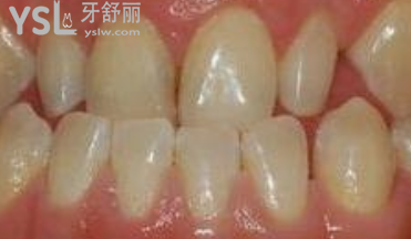 對刃頜的危害是什么，對刃頜矯正需要多少錢有必要嗎