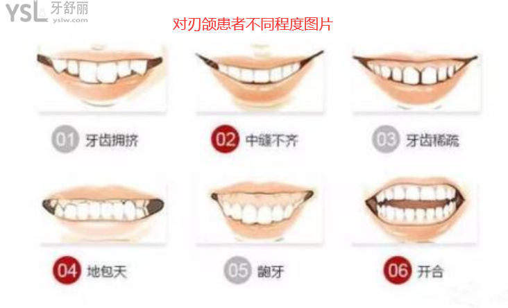 對刃頜的危害是什么，對刃頜矯正需要多少錢有必要嗎