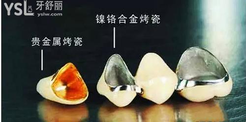 金屬冠