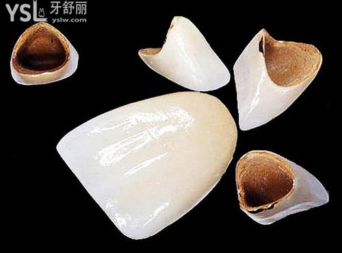 金屬烤瓷冠