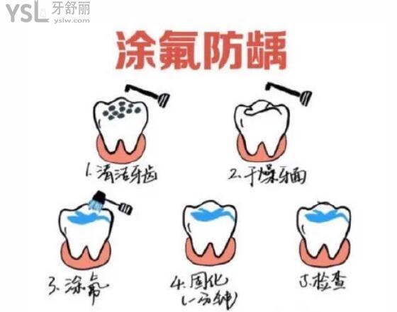 涂氟防齲齒