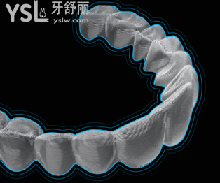 正雅隱形牙套價格多少錢