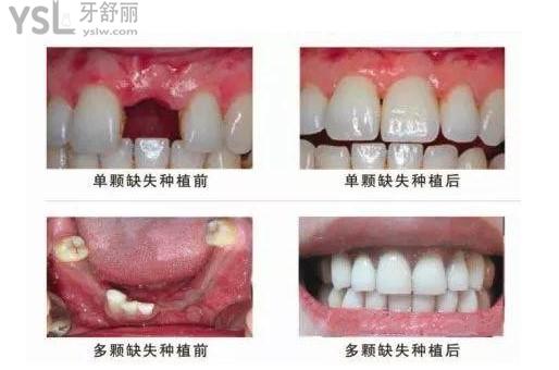 種植牙<span style=