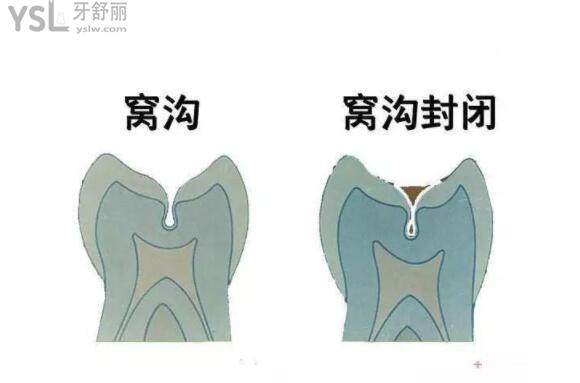 窩溝封閉