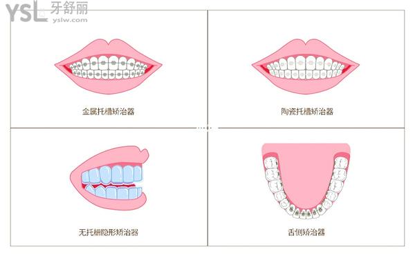 常見四種矯正器