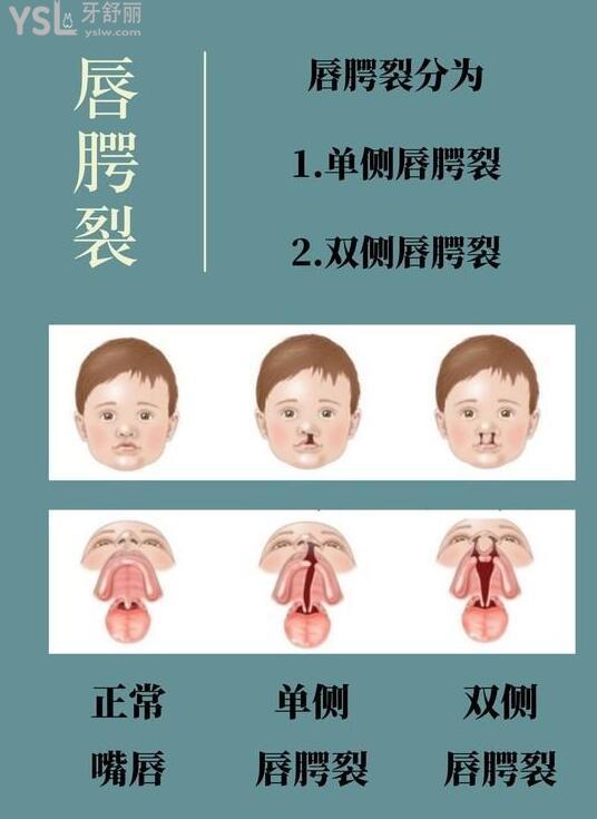 唇腭裂修復(fù)手術(shù)大概需要多少費用.jpg