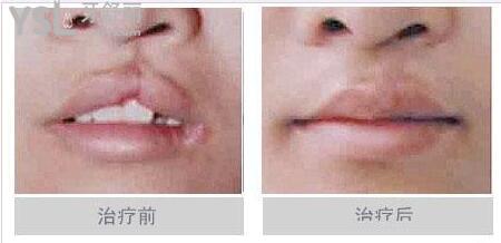 唇腭裂修復(fù)手術(shù)大概需要多少費用.jpg