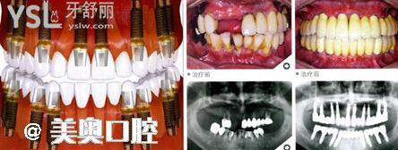深圳美奧口腔醫(yī)院是**定點單位嗎 老年人種植牙又便宜又好.jpg