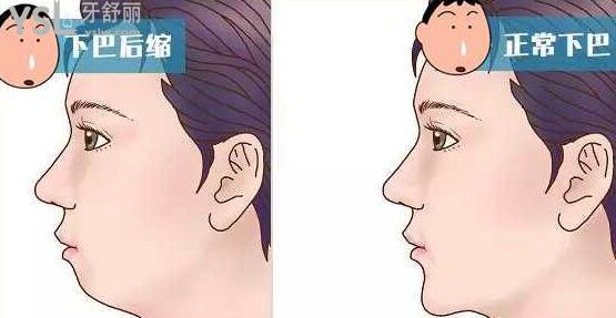 嘴突下巴后縮單純整牙可以改善嗎.jpg