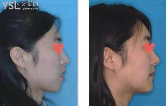 嘴突下巴后縮單純整牙可以改善嗎.jpg
