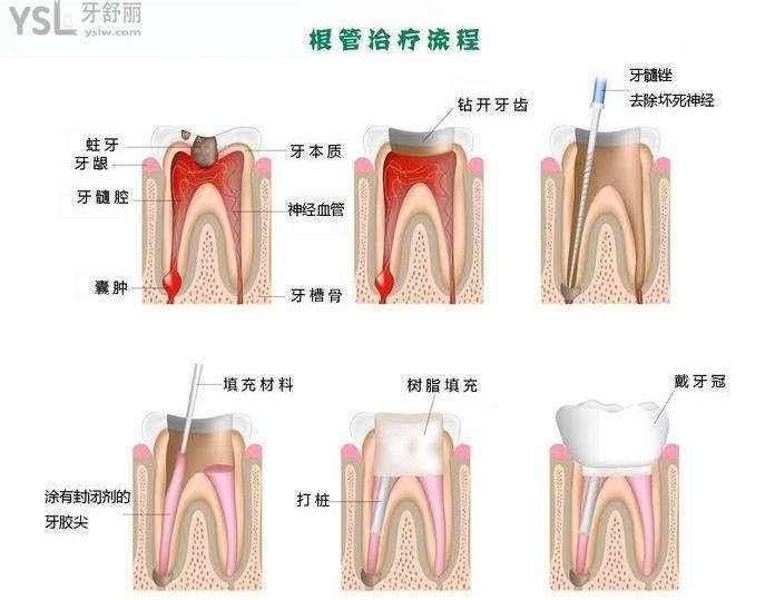 根管治療流程