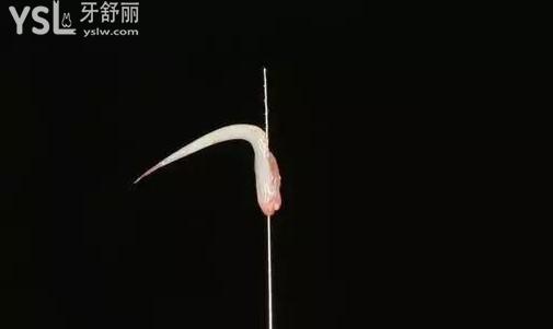 抽牙神經(jīng)圖