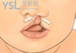 腭裂修復后能跟正常人一樣嗎