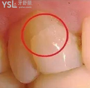 牙隱裂
