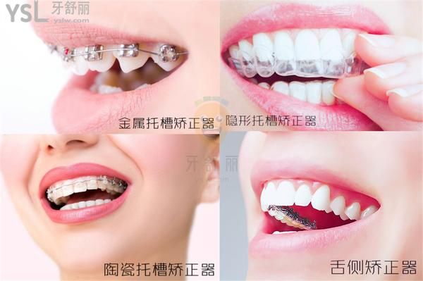 牙齒矯正器哪種成效比較好?選擇恐懼癥必看!