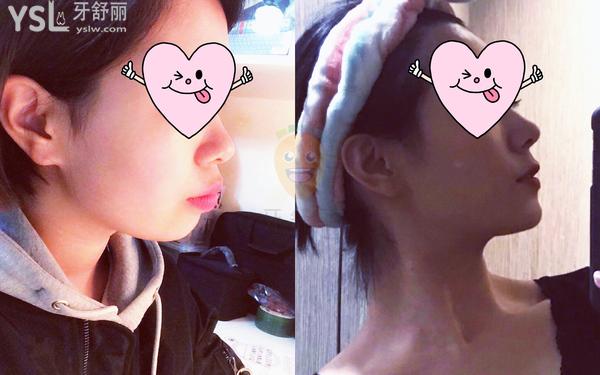 牙齒矯正器哪種成效比較好?選擇恐懼癥必看!