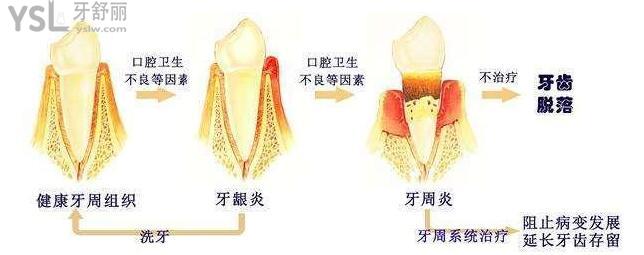 牙齦炎牙周炎和牙髓炎的癥狀和區(qū)別.jpg