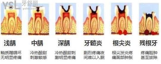 牙齦炎牙周炎和牙髓炎的癥狀和區(qū)別.jpg