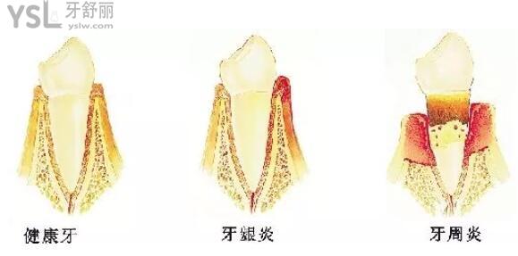 牙周炎