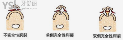唇腭裂能完全修復(fù)好嗎