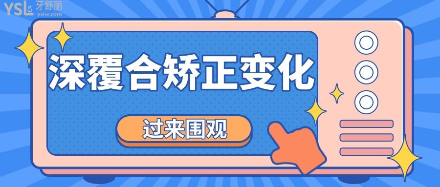 深覆合矯正臉型變化圖 .jpg