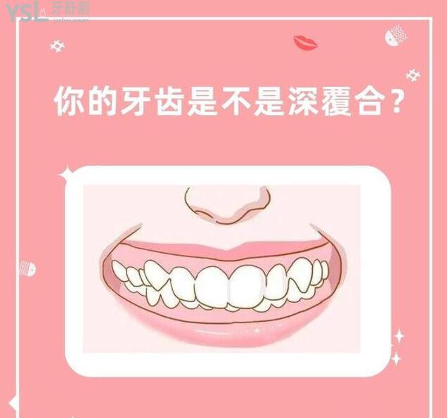 深覆合矯正臉型變化圖 .jpg