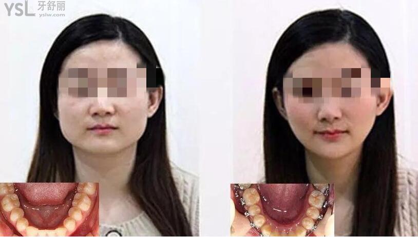 深覆合矯正臉型變化圖 .jpg