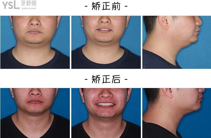深覆合矯正臉型變化圖 .jpg