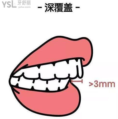 深覆合