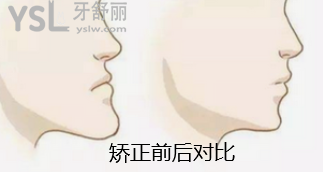 骨性地包天不做手術(shù)可以矯正嗎