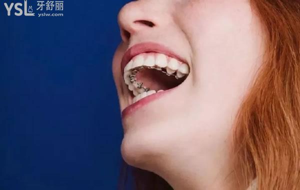 舌側牙齒矯正器