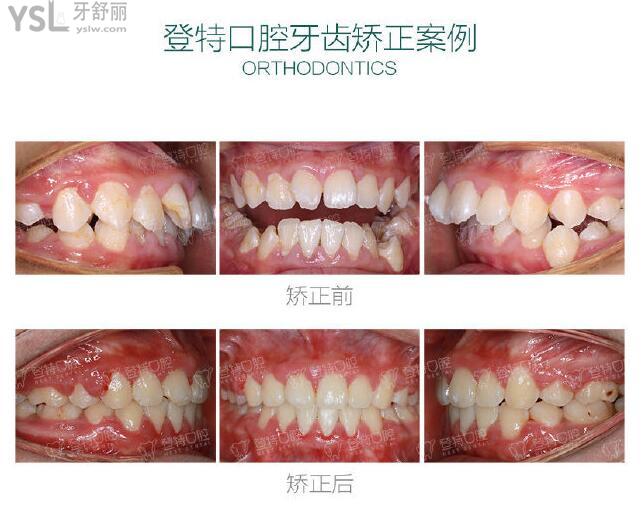 深圳登特口腔醫(yī)院正規(guī)嗎 網(wǎng)友推薦的矯正醫(yī)生需要花多少錢 .jpg