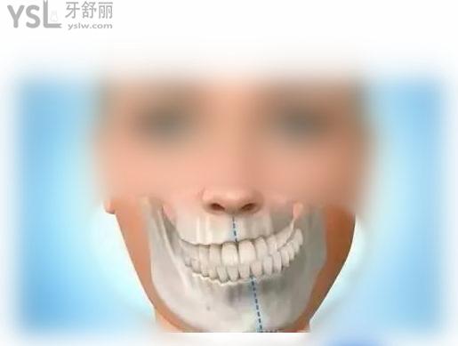 嘴歪