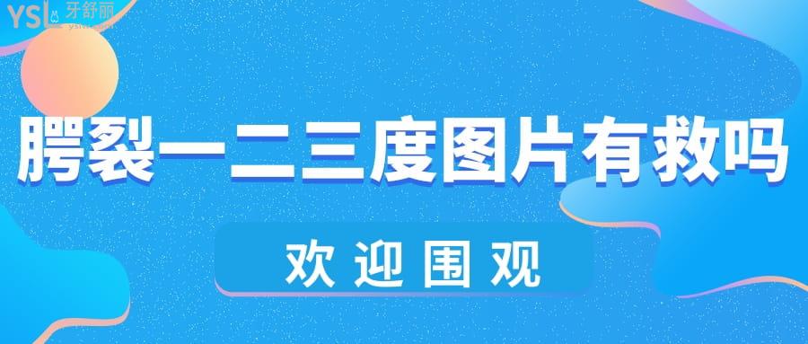 腭裂一二三度圖片有救嗎