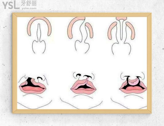 腭裂一二三度圖片有救嗎
