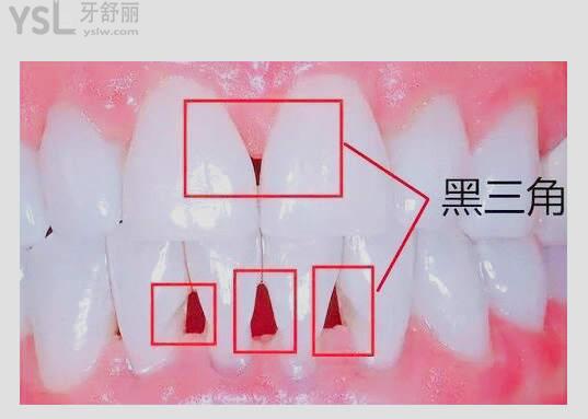 牙齦萎縮