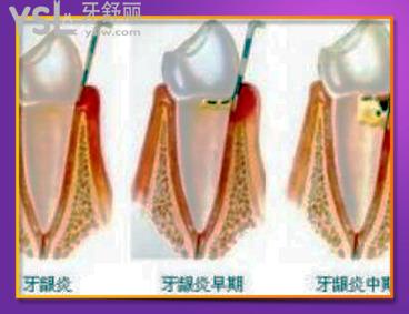 牙髓炎會(huì)傳染給別的牙嗎