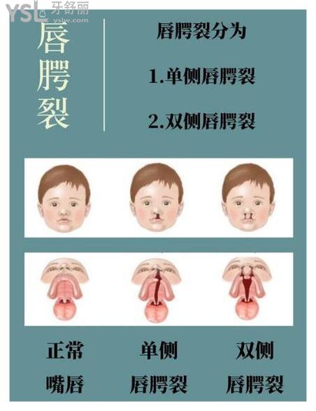 唇腭裂修復(fù)手術(shù)什么時候做比較好.jpg