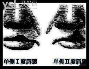 唇腭裂可以完全修復(fù)嗎 多少錢.jpg