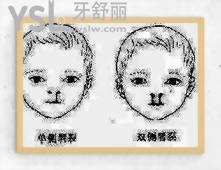 唇腭裂可以完全修復(fù)嗎 多少錢.jpg