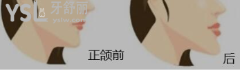 側(cè)臉不好看嘴突出怎么辦
