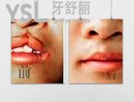 唇腭裂可以完全修復(fù)嗎 多少錢.jpg