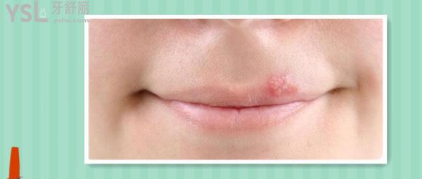 嘴唇上火起泡怎么消除用什么藥.jpg