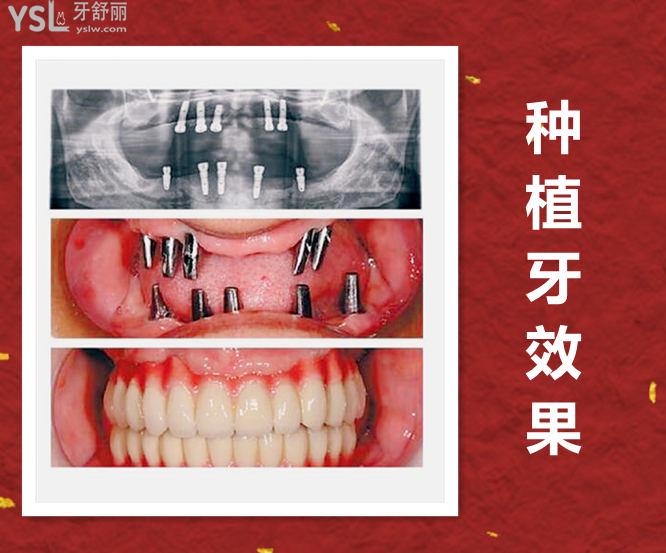 種植牙