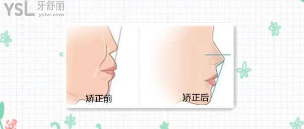 較重的齙牙矯正多久可以看到成效，一定要注意這幾方面