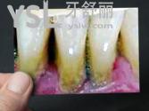牙床萎縮露出牙根怎么才能