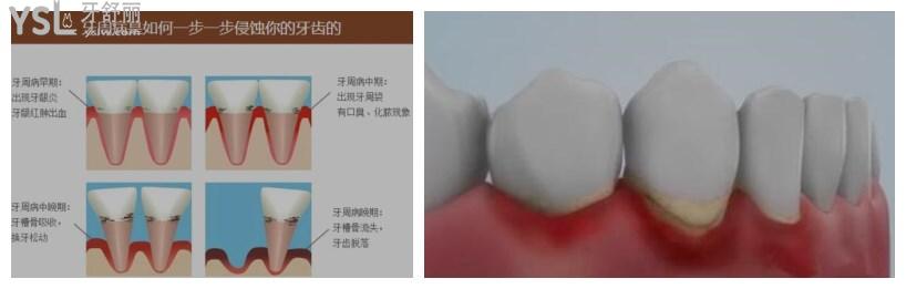 牙周炎和牙齦炎的根本區(qū)別