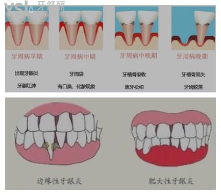 牙周炎和牙齦炎的根本區(qū)別