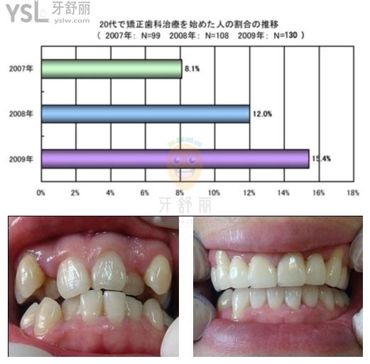日本人為什么不矯正牙齒，牙齒亂為什么卻很少正畸