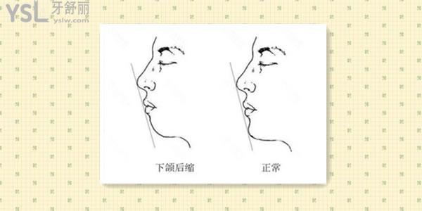 整牙能改善下巴后縮嗎.jpg